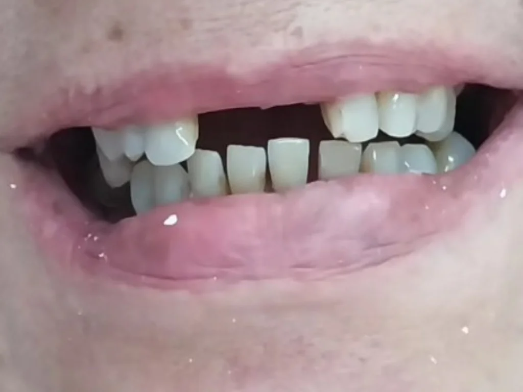 Sorriso antes do tratamento