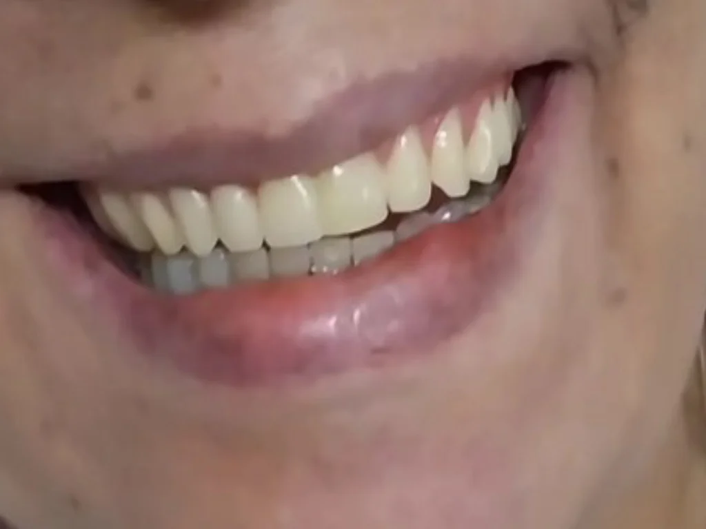 Sorriso após o tratamento